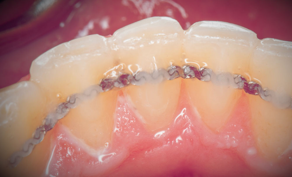 L’après-contention en orthodontie – L'Information Dentaire