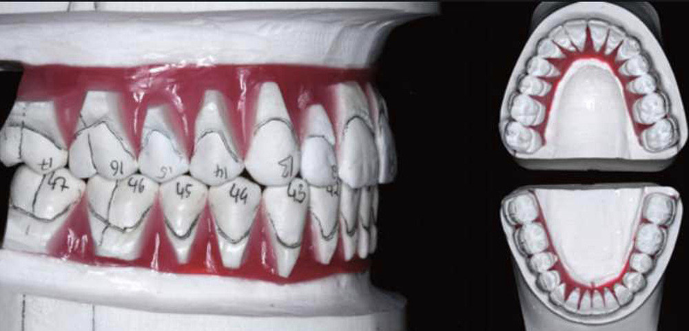 Conception et fabrication « in office » des gouttières orthodontiques  thermoformées à l'aide du logiciel 3Shape Clear Aligner Studio –  L'Information Dentaire