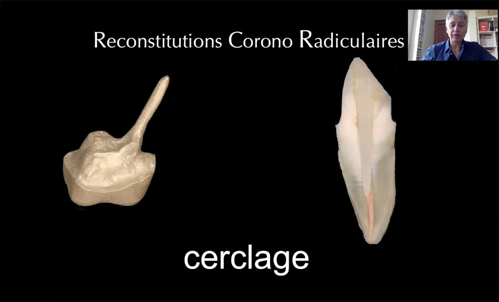 Importance de la notion de cerclage dans les reconstitutions coronoradiculaires L