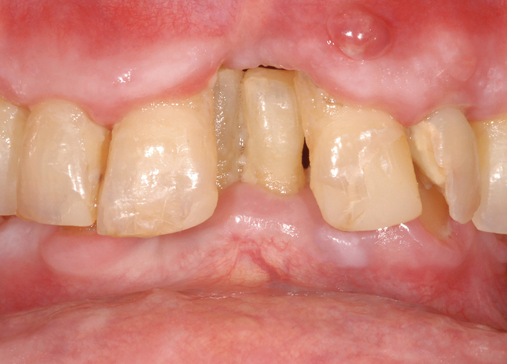 Usure Dentaire Normale Ou Pathologique L Information Dentaire