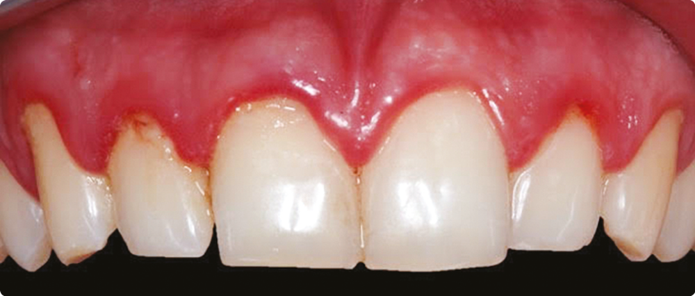 elfbar nachfüll pod läuft aus Les ZYNs sont-ils mauvais pour vos gencives ? Sacs de nicotine et santé  bucco-dentaire main image 0