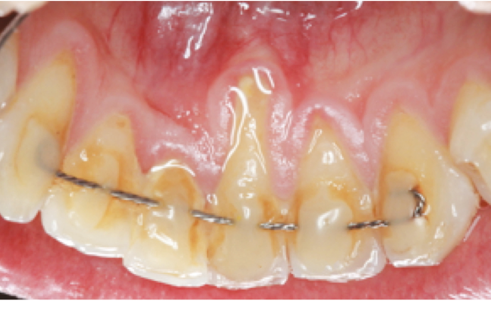 Le « syndrome du fil » de contention collé en orthodontie – L