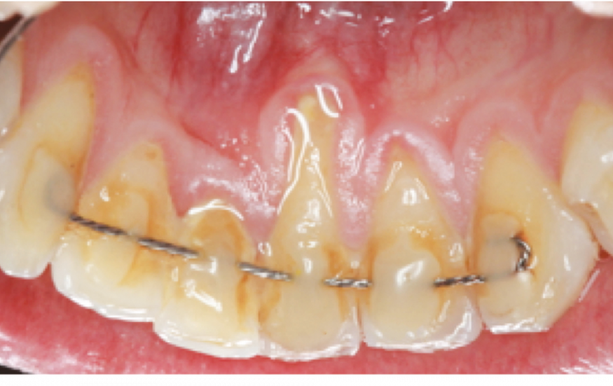 Le « syndrome du fil » de contention collé en orthodontie – L'Information  Dentaire