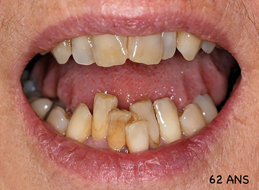 Dent Qui Bouge Physiologique  - • Le Teste De Percussion Émet Un.