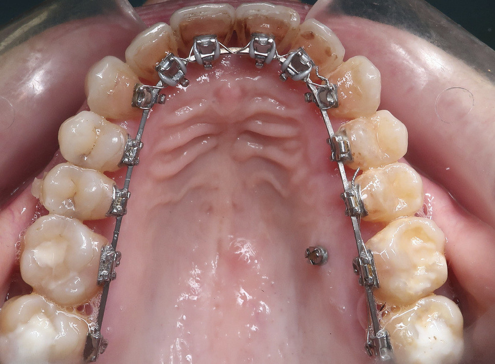 Le point sur les différentes techniques orthodontiques (fixes versus  aligneurs) : indications chez l'adulte et incidences parodontales –  L'Information Dentaire