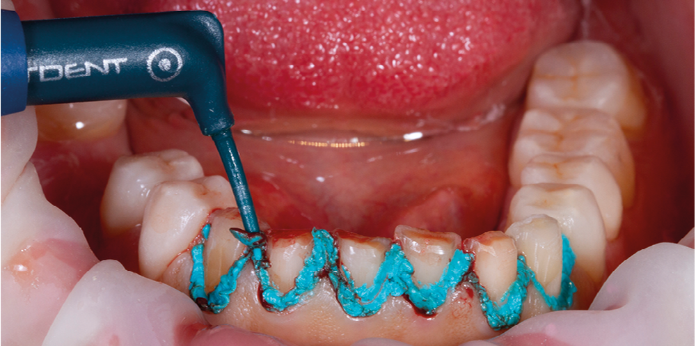 Dentier provisoire, une solution pour ne pas rester sans dents - Dent  Provisoire
