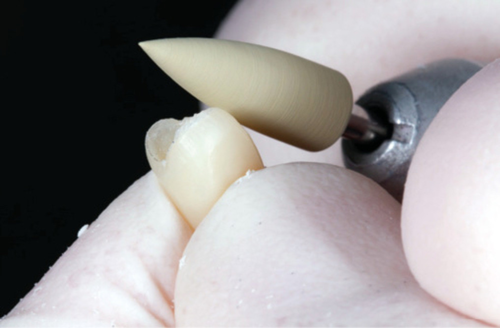 Restaurations esthétiques des molaires temporaires par CFAO – L'Information  Dentaire