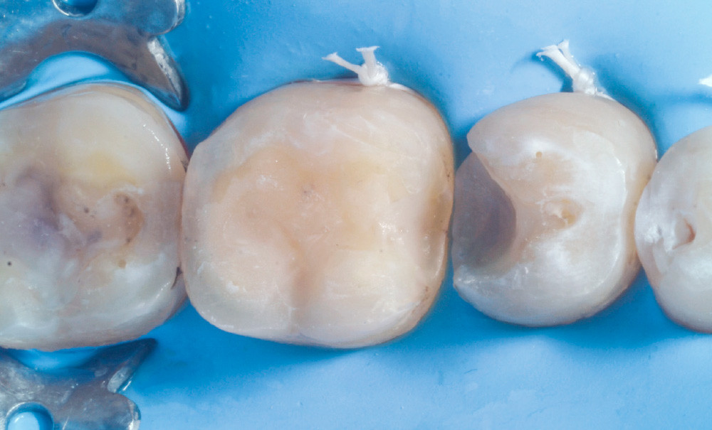 La digue dentaire - ResiDentaire™  Plateforme de QCM Médecine Dentaire