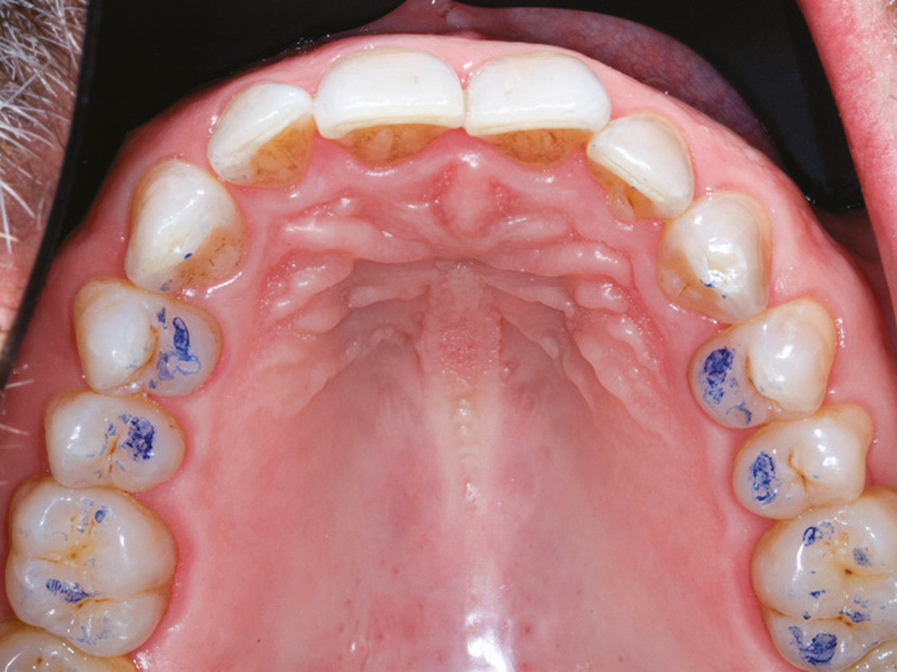 Papier Articulé Dentaire, Matériel Dentaire