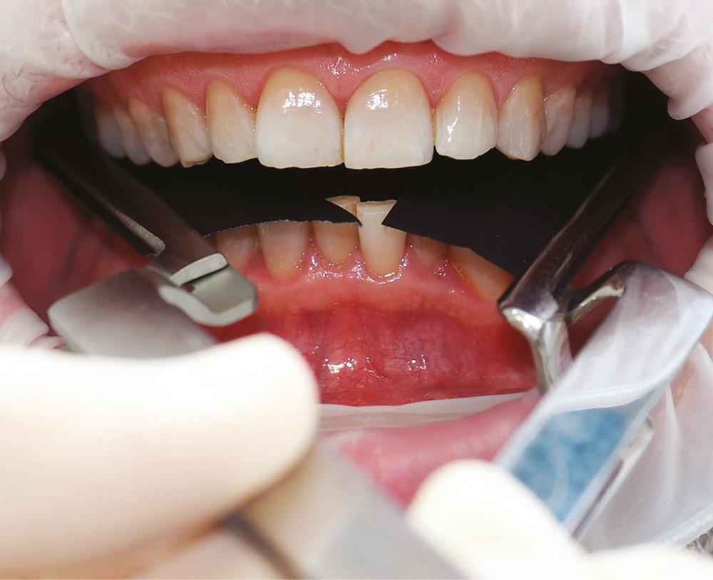 Les papiers marqueurs de l'occlusion (Partie 2) – L'Information Dentaire
