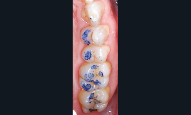 Film épais/fin bleu/rouge d'occlusion papier dentaire articulé