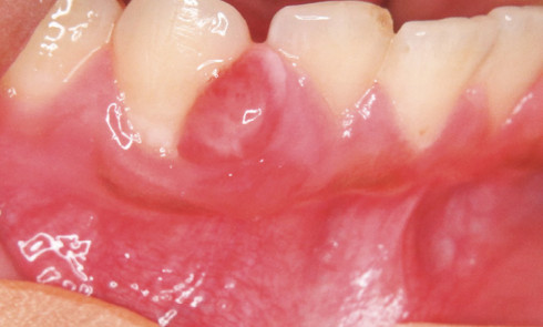 Blanc Ou Noir Sur Le Palais Du Nourrisson L Information Dentaire