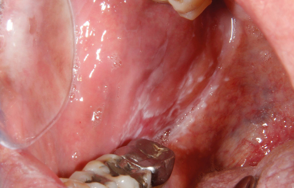 À propos de lésions buccales chroniques généralisées en période de pandémie Covid-19 – L'Information Dentaire