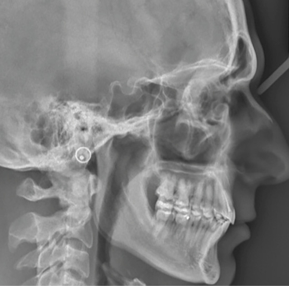 Syndrome Tonique Du Muscle Tenseur Du Tympan Traitement