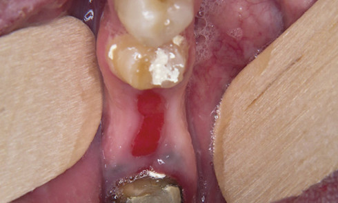 Blanc Ou Noir Sur Le Palais Du Nourrisson L Information Dentaire