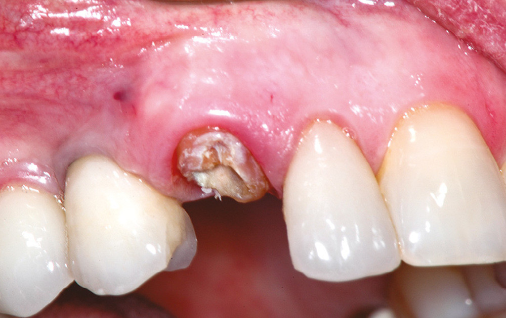 Extraction implantation immédiate et choix raisonné du matériau de  comblement – L'Information Dentaire