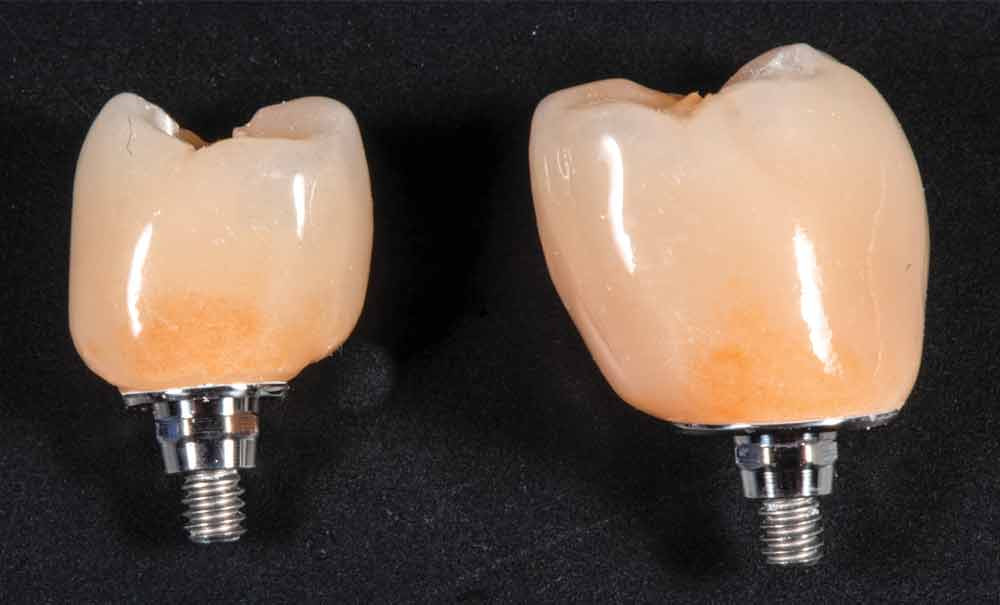 Embase titane et couronne céramique un duo gagnant en prothèse fixée sur implant ? L
