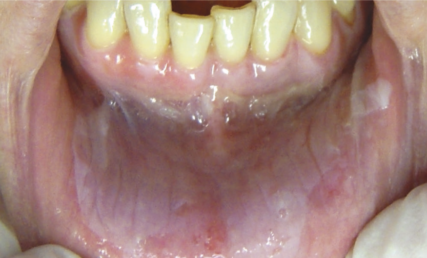 Brûlures orales iatrogènes de nature chimique – L'Information Dentaire