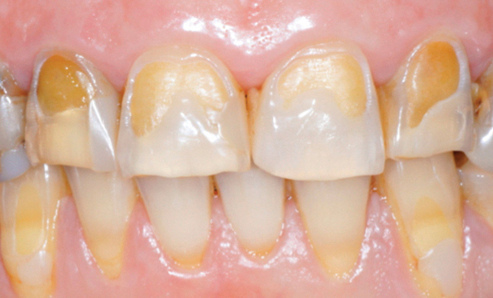 L’orthodontie dans le traitement des lésions érosives L