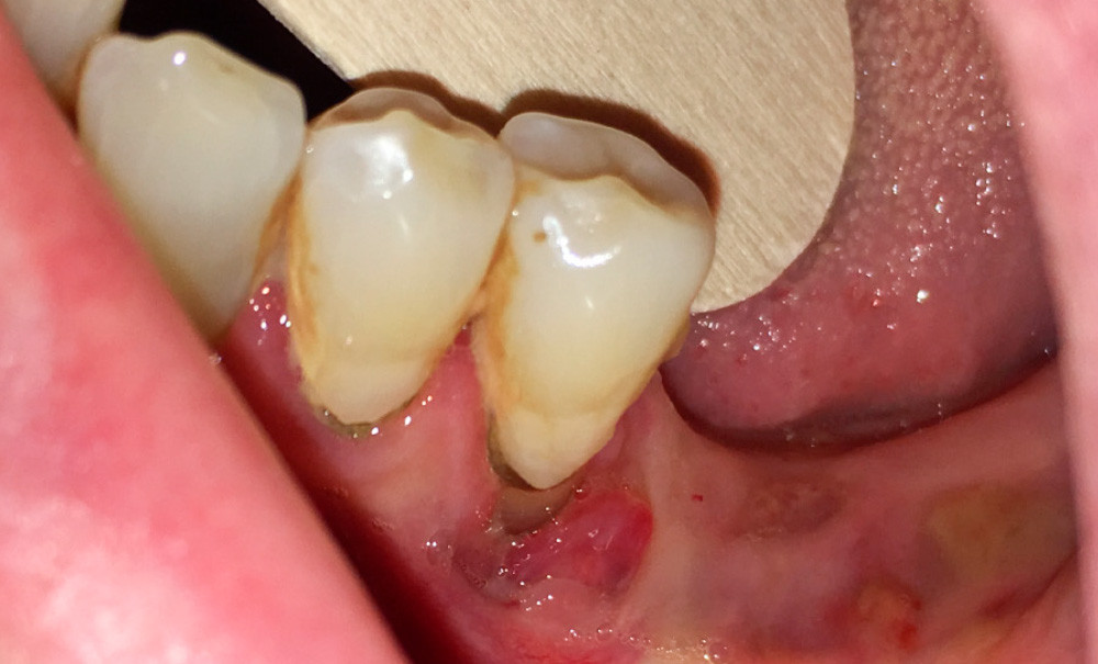 Prise en charge des patients sous biothérapie au cabinet dentaire –  L'Information Dentaire