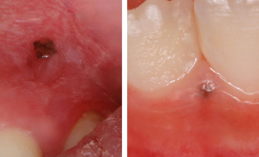 melanotic macule sur la bouche Quand c'est noir, ça inquiète ! – L'Information Dentaire