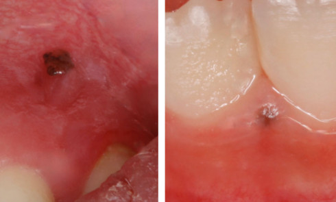 Boule Sublinguale La Conduite A Tenir L Information Dentaire