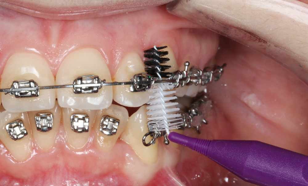 Les brossettes interdentaires Pour qui ? Quand ? Comment ? L