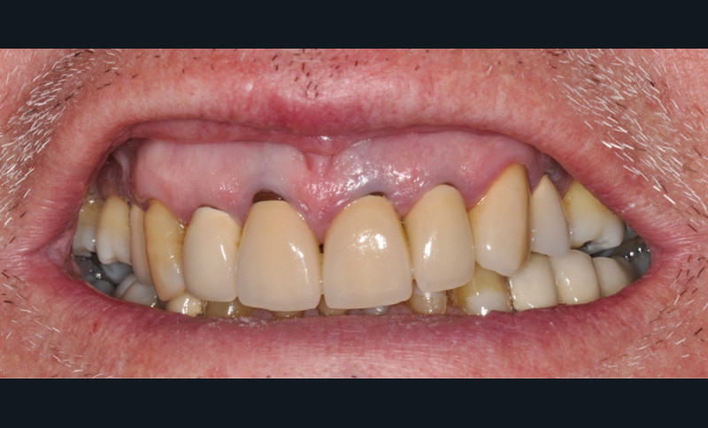 Aligner les collets grâce à la chirurgie muco-gingivale – L'Information ...