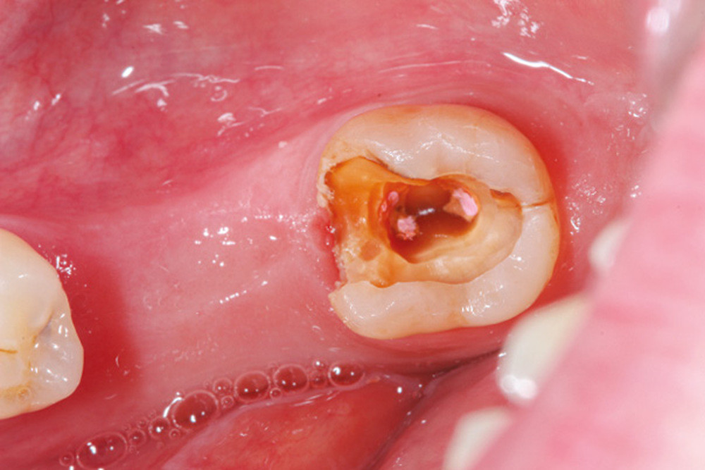 Extraction dentaire : quand, durée, déroulé, soins après