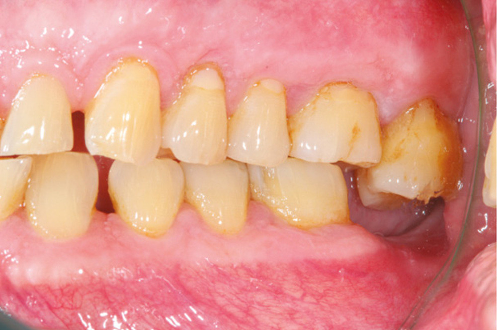 Les conséquences du non-remplacement des dents extraites ou absentes –  L'Information Dentaire