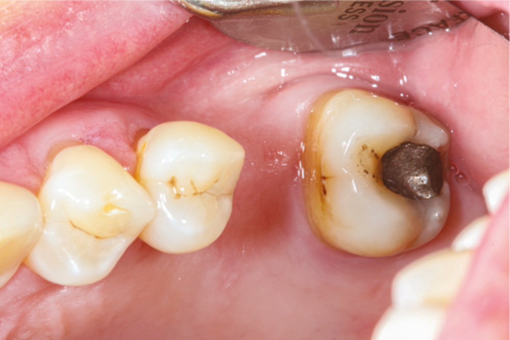 Se faire enlever une dent par votre dentiste : ce qu'il faut savoir