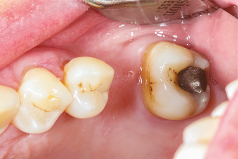 Les conséquences du non-remplacement des dents extraites ou absentes –  L'Information Dentaire