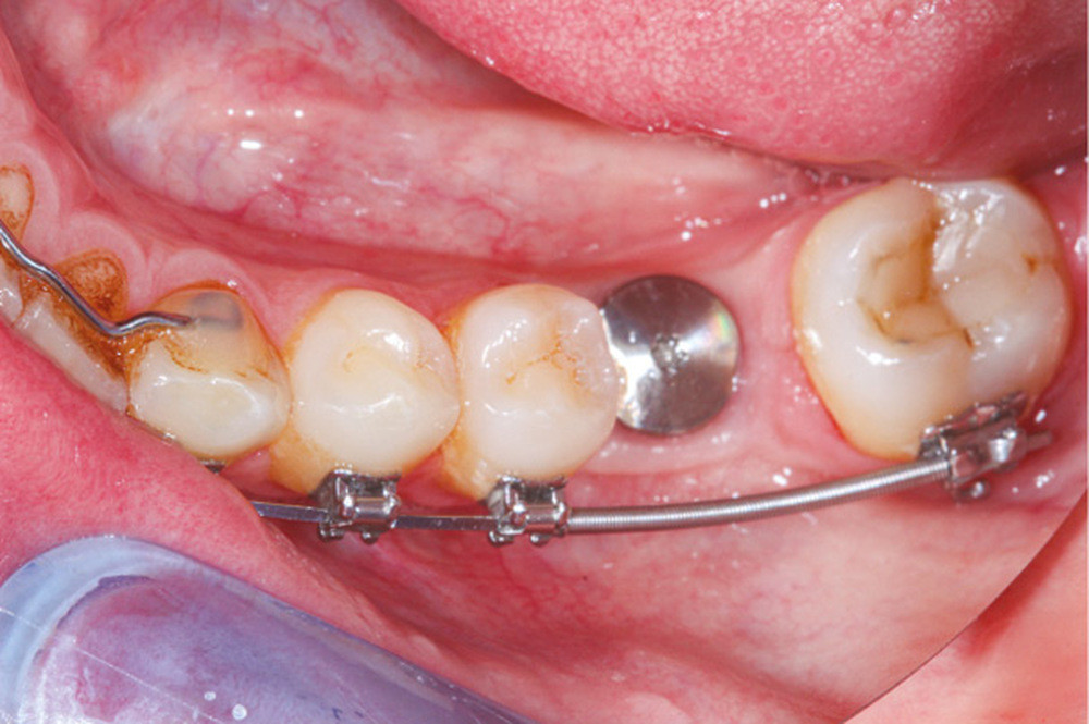 Les conséquences du non-remplacement des dents extraites ou absentes –  L'Information Dentaire