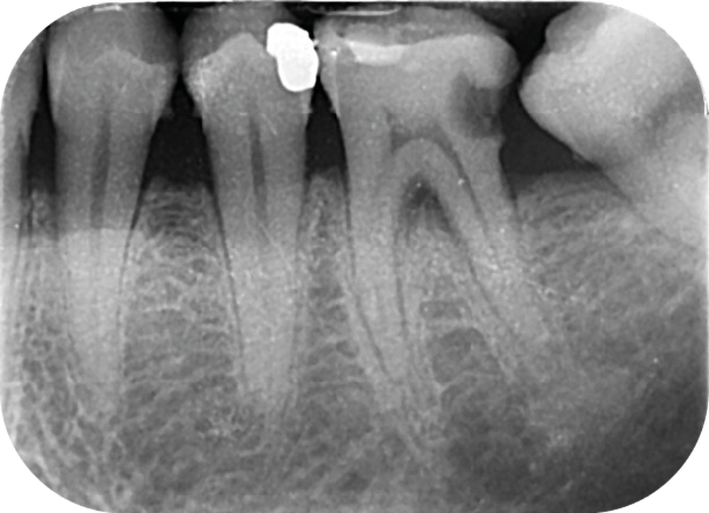 Extraction de dents incluses, Cabinet dentaire Massena