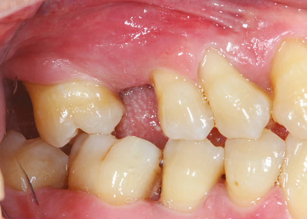 Les conséquences du non-remplacement des dents extraites ou absentes –  L'Information Dentaire