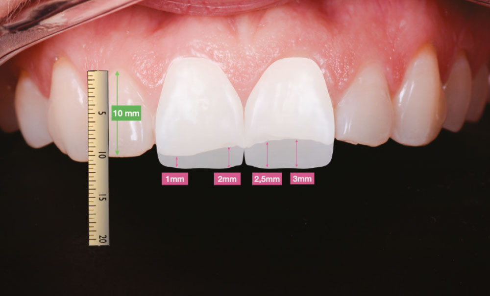 Les facettes dentaires, une thérapeutique minimalement invasive –  L'Information Dentaire