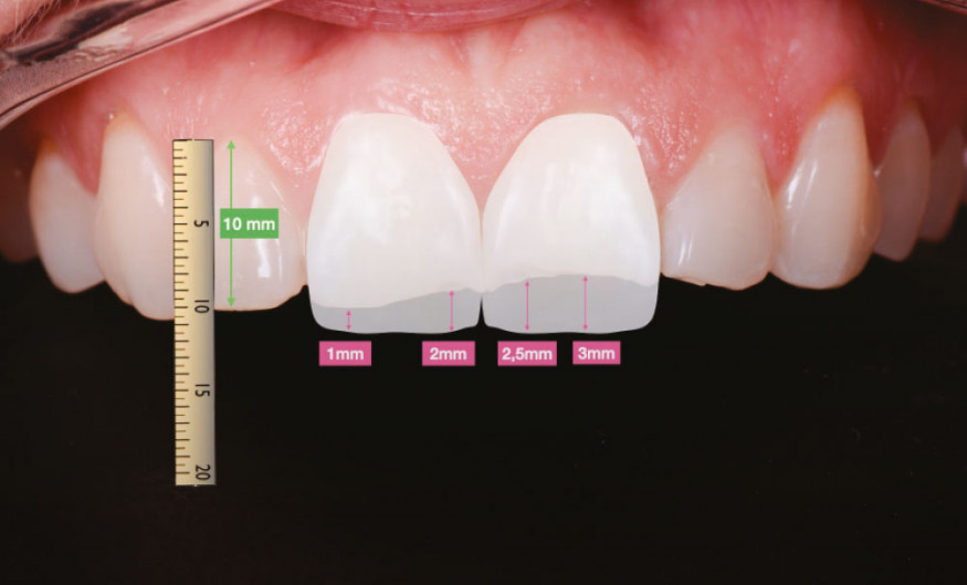 Les facettes dentaires, une thérapeutique minimalement invasive
