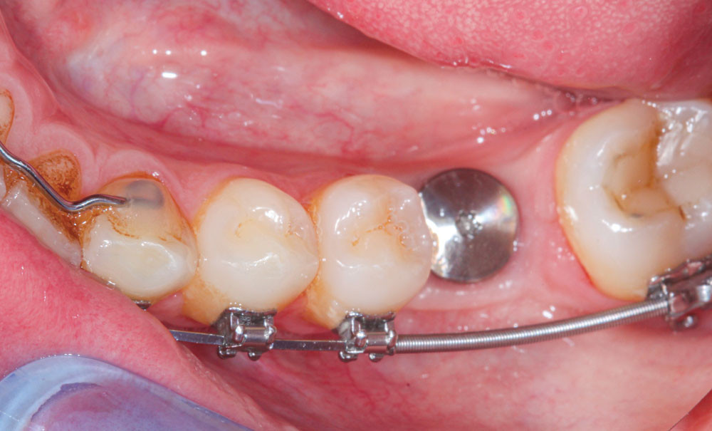 Les Consequences Du Non Remplacement Des Dents Extraites Ou Absentes L Information Dentaire