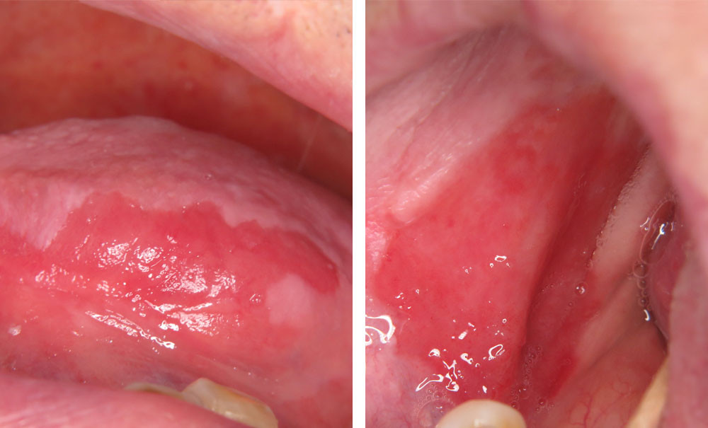 Lésions rouges évocatrices d’une néoplasie maligne débutante L