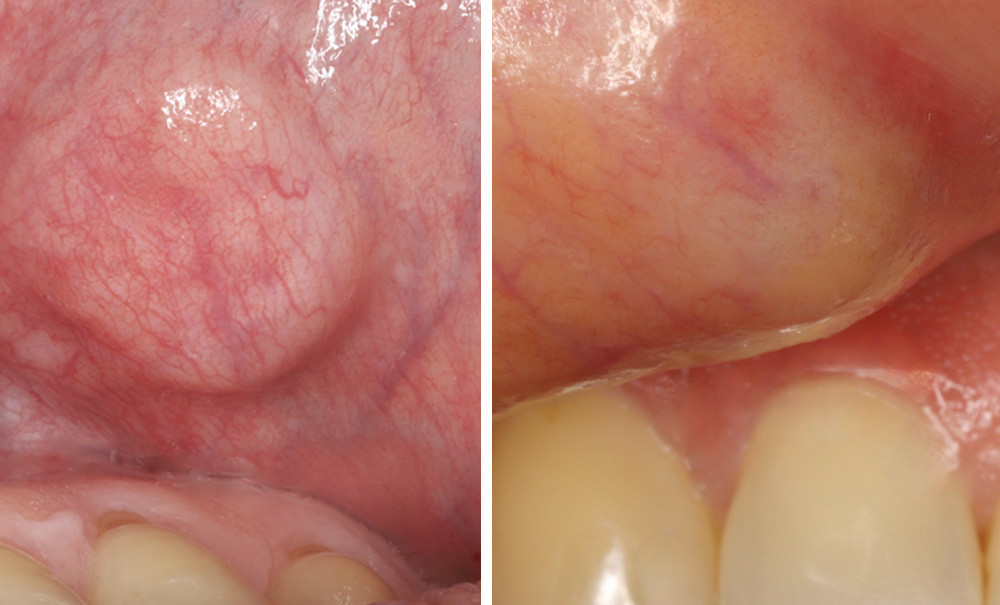 Glandes salivaires accessoires et tumeurs – L'Information Dentaire