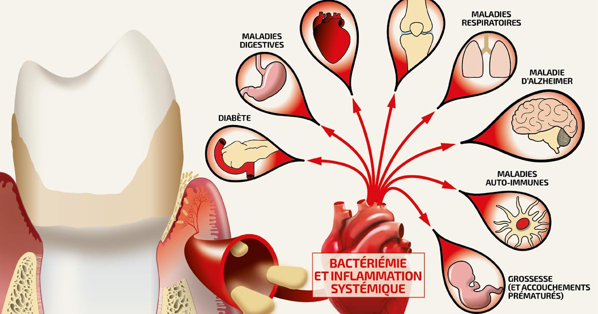 Parodontite et maladies systémiques explication des mécanismes L — free download