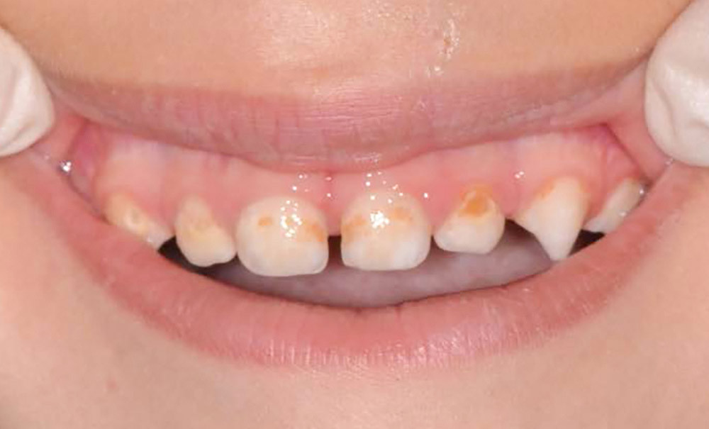Pourquoi soigner les dents temporaires cariées des enfants ? L