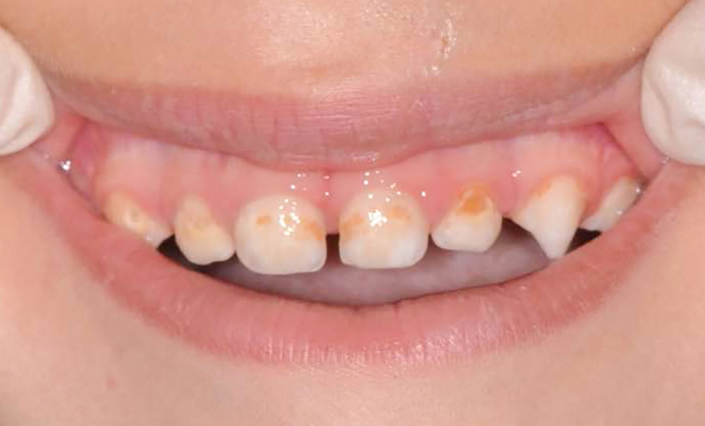 enfant-8-ans-dents-écartées-en-avant-sartrouville-apres-2