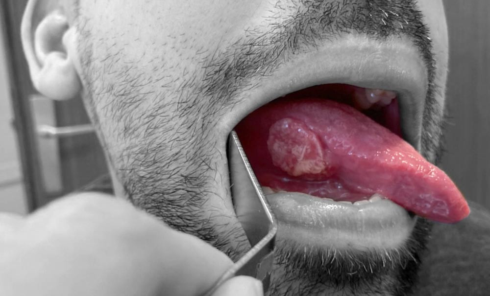 Carcinomes de la cavité orale sans facteurs de risque identifiés ...
