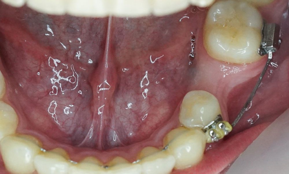 Restaurations esthétiques des molaires temporaires par CFAO – L'Information  Dentaire