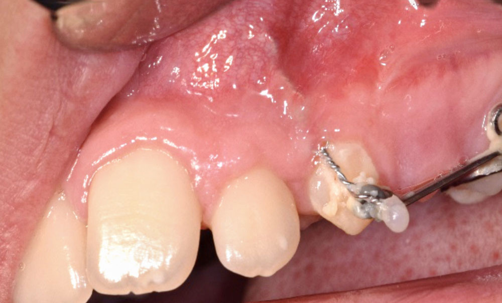 Dents Incluses Ou En Désinclusion. – ECCKF