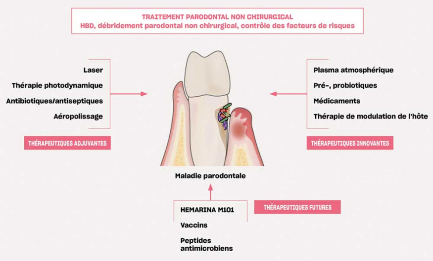 Le point sur les différentes techniques orthodontiques (fixes versus  aligneurs) : indications chez l'adulte et incidences parodontales –  L'Information Dentaire