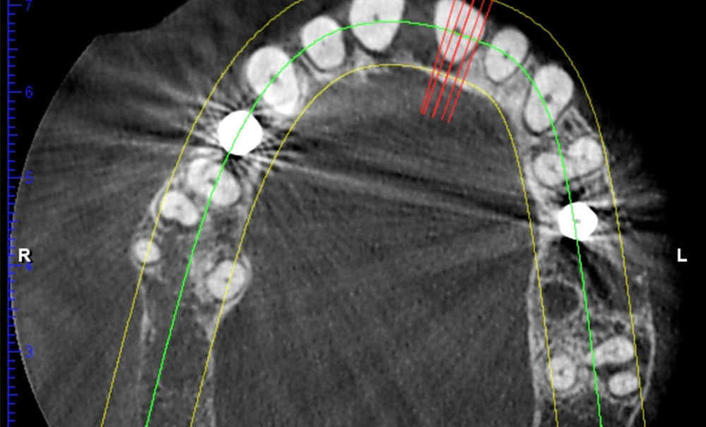 Pièce à Main Prophy Pour Hygiène Dentaire - Cône De Nez 4:1 Type E Avec Attache Pivotante, Neuve