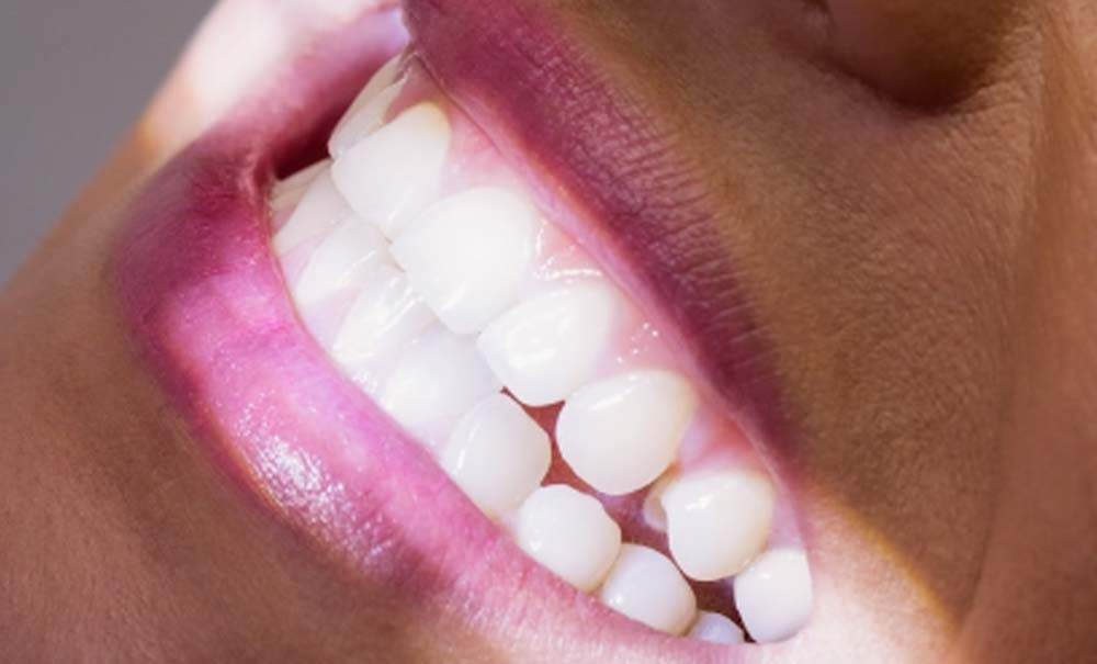 Blanchiment des dents, trop de produits nocifs ou inutiles » –  L'Information Dentaire