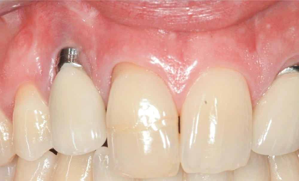 Traitement d’une déhiscence vestibulaire péri‑implantaire incisions